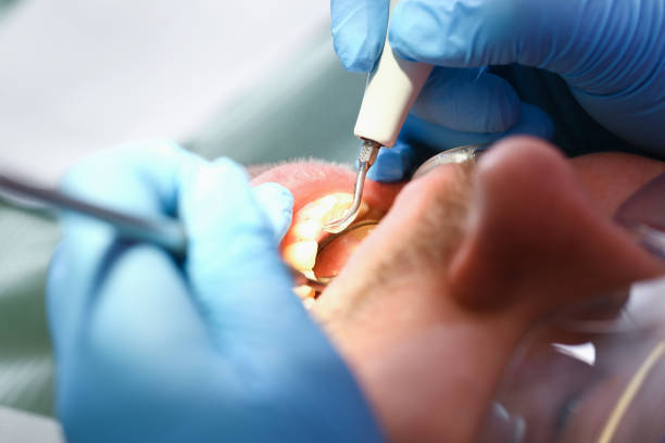 Best Emergency Root Canal Therapy in Cape St Claire, MD