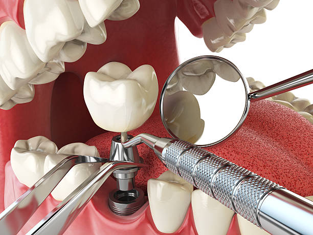 Best Emergency Denture Repair in Cape St Claire, MD